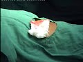 Medical thoracoscopy incision