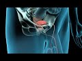 Radical Prostate Cancer Surgery Animation