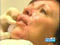 NEW PERLANE RESTYLANE WITH DALLAS FACIAL PLASTIC SURGEON