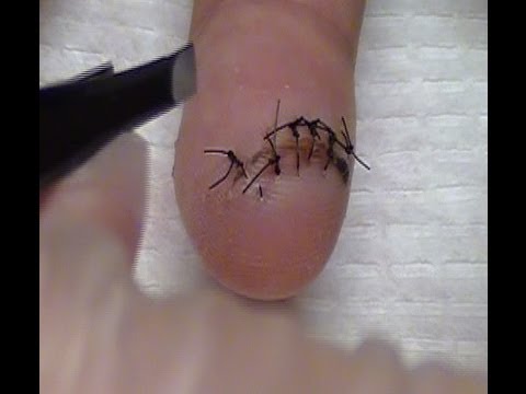 how to remove sutures