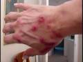 videos de The Morgellons Lesion