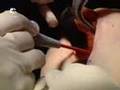 La cirugÃa estética ya no es sólo para los ricos