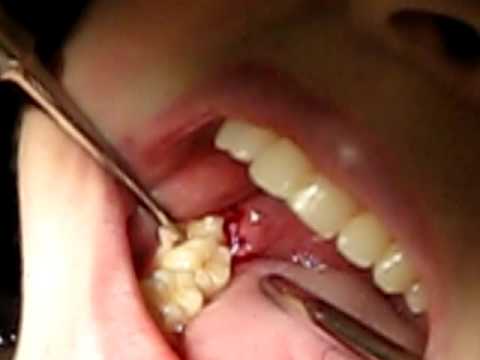wisdom tooth extraction costs pennsylvania