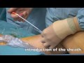VNUS ClosureFast Treatment in the Netherlands