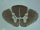Thoracic Cord
