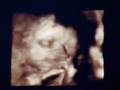 videos de Chloe's First Video (3D Sonogram) Part 1