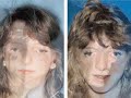 Treacher Collins Syndrome Treacher Collins Syndrome