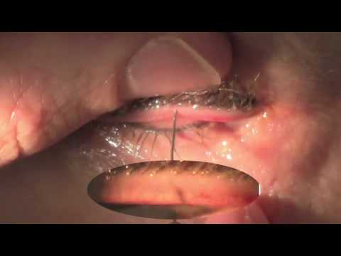 how to unclog meibomian gland