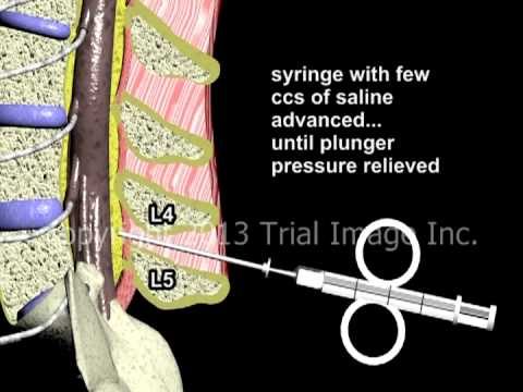 how to perform spinal anesthesia