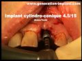 Implants Dentaires : Extraction Et Mise En Esthétique Immédiate