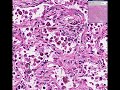 Histopathology Lung --Organizing pneumonia Histopathology Lung --Organizing pneumonia