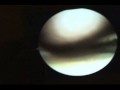 The Doctor Biehl Show - Knee Arthroscopy