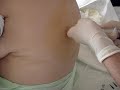 Puncion Pleural