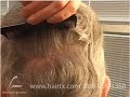 HAIR TRANSPLANT IN DALLAS:  TRICHOPHYTIC DONOR CLOSURE REDUX