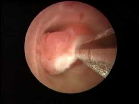 endometrial polyp shaver (IUR) procedure
