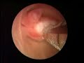 endometrial polyp shaver (IUR) procedure