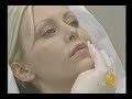 Laugh Line Injections