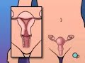 PreOp® Patient Education Women: Dilation and Curettage Dilation And Curettage