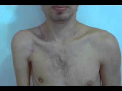 Transfer of the Motor Branch of Platysma to Nerve XI