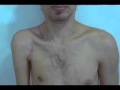 Transfer of the Motor Branch of Platysma to Nerve XI