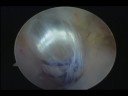 PCL reconstruction remnant augmentation transseptal portal PCL reconstruction remnant augmentation transseptal portal