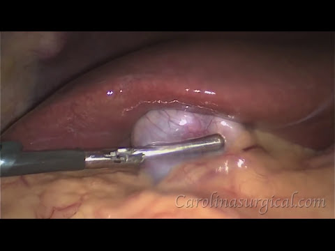 how to perform gallbladder surgery