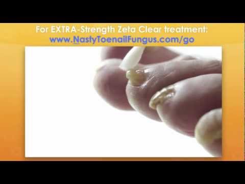 how to dissolve toenails