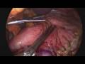 Vertical sleeve gastrectomy procedure from www.lapsf.com
