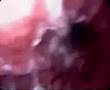 videos de NHS Colonoscopy