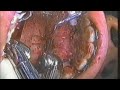 Maxillary Lingual Corticotomy Pt 3-B