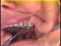 Removing Periodontal Dressing
