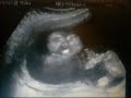 16week Ultrasound Scan