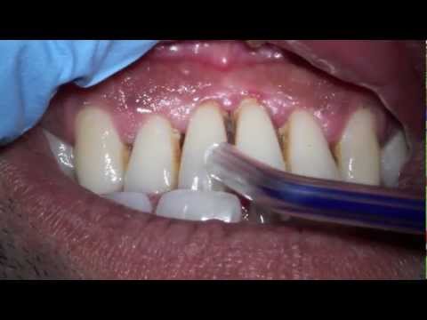 how to treat gum infection