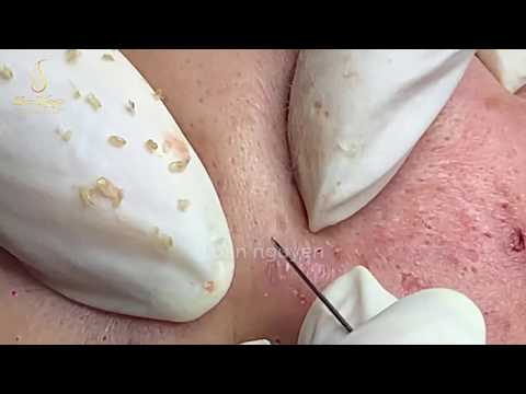 How to Get Rid of Blackheads on the face | Loan Nguyen