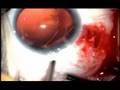 Cionni Modified Capsular Tension ring in Marfan Syndrome