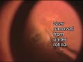 Removal of Subretinal Membrane (Scar) Removal of Subretinal Membrane (Scar)