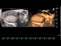 Targestar ® P-HF in Myocardial Perfusion Imaging