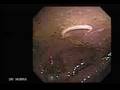 Video Colonoscopy Showing a Parasite in the Cecum