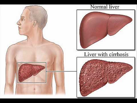 how to cure hep b reactive