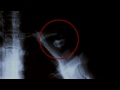 How long it takes to break a collar bone mountain biking - 2:48 minutes
