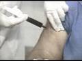 Cuidado com a Auto-Hemoterapia