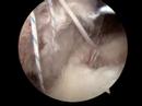 Rotator Cuff Repair