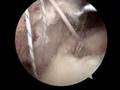 Rotator Cuff Repair
