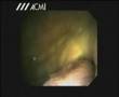 My Cystoscopy