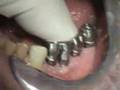 Partial Mandibular Posterior, replace 34-37