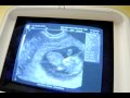 4/6/2010 Ultrasound #2, Week 10