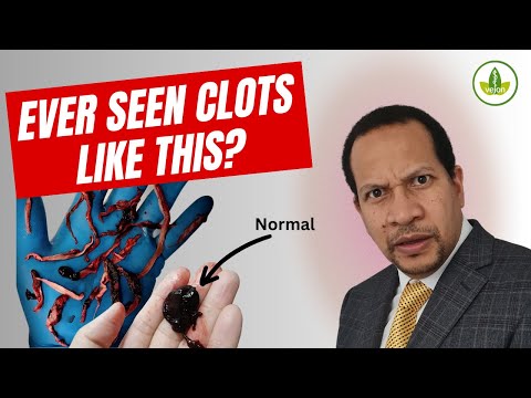 Have you ever seen Clots like this? DO NOT WATCH if squeamish