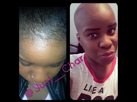 how to cure alopecia