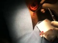 Remove Pilar Cyst