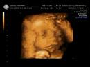 AhBu 27th weeks (4D)